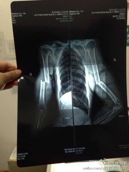 圖為微博上傳“范某某的妻子顧盤(pán)珍手被打斷。”