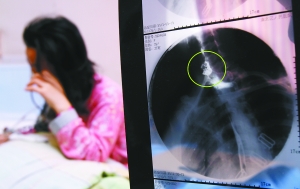 假牙上的鋼絲刺破食管，而薄薄的食道壁緊貼主動(dòng)脈血管，極易造成血管破裂