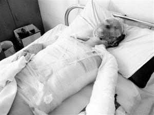 周小姐的頭、頸、軀干、四肢均被燒傷，其中面部燒傷最為嚴(yán)重。