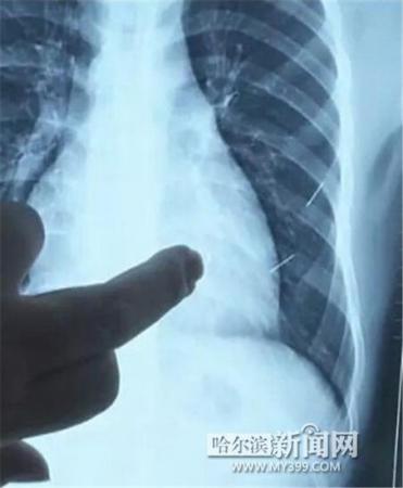 17歲少年體內扎進4根鋼針 1根已插入心臟4厘米 17歲少年體內扎進4根鋼針 1根已插入心臟4厘米