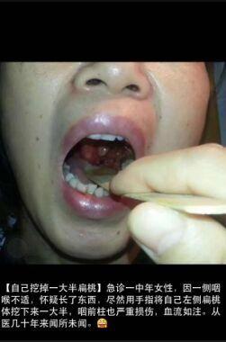 圖片來自市三醫院耳鼻喉科醫生朋友圈