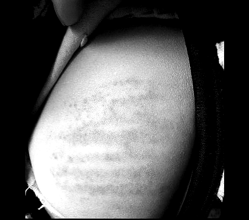 沒帶作業本 信陽潢川4歲娃兒遭老師輪番鞭打