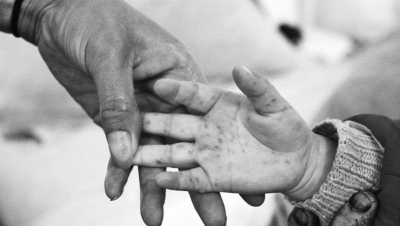 手足口病進入高發季 河南省幼兒園開始每日晨檢 手足口病進入高發季 河南省幼兒園開始每日晨檢