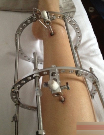 矯正"O型腿"手術全過程