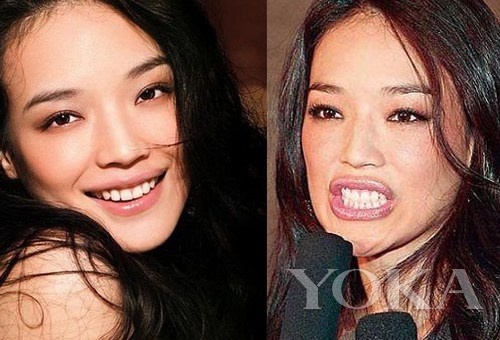 牙齒凸出,口輪肌過于松弛 牙齒凸出,口輪肌過于松弛