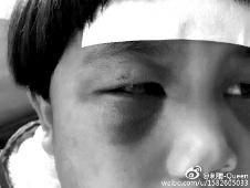 6月2日，網曝渭南市臨渭區一不滿5歲的女童遭奶奶毆打，眼圈青腫，引起網友關注，但孩子父母和爺爺均稱是摔倒導致。相關部門介入調查發現確為奶奶毆打所致，鑒于其身體原因已進行批評教育。