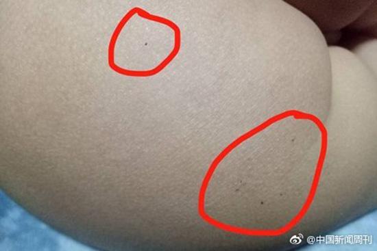 據(jù)多名紅黃藍(lán)(新天地分園)家長(zhǎng)反映，孩子腿部、屁股、腋下出現(xiàn)針眼。