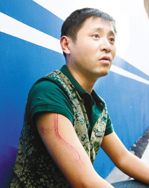 被該乘客抓傷手臂的鐘先生 被該乘客抓傷手臂的鐘先生