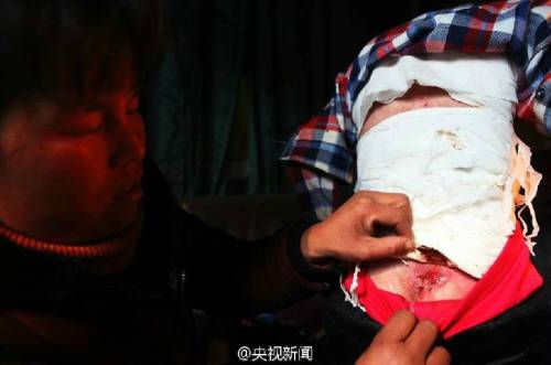 男孩皮膚一碰就破 裹衛生紙堅持上學