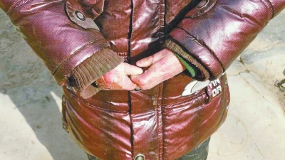 長期受損的手指，已經(jīng)長在了一起。