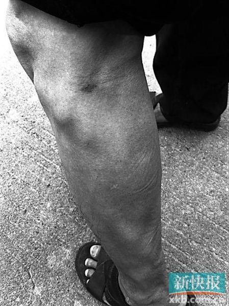 傷者身上遺留的彈痕。 傷者身上遺留的彈痕。