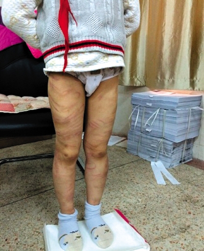 4月3日晚，微博網(wǎng)友“@朝廷半日閑”發(fā)圖文微博展示男童被虐待的慘狀。 微博截圖