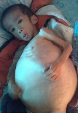 湖北5歲男孩患怪病肚子長(zhǎng)成“大冬瓜”(圖) 湖北5歲男孩患怪病肚子長(zhǎng)成“大冬瓜”(圖)