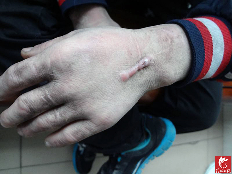 被發現男子手上的傷疤。