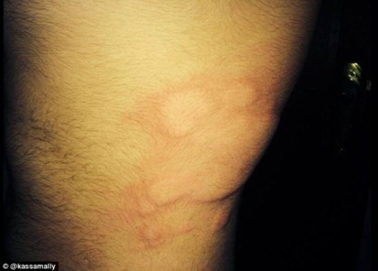 IS被指在敘利亞使用化學武器 有居民失明起水泡 IS被指在敘利亞使用化學武器 有居民失明起水泡