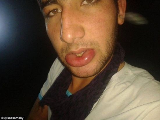 IS被指在敘利亞使用化學武器 有居民失明起水泡 IS被指在敘利亞使用化學武器 有居民失明起水泡