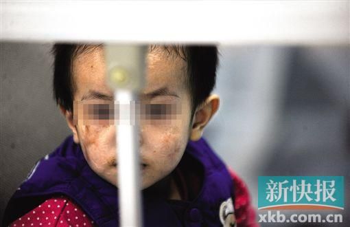 去年3月就能出院的小華(化名),目前還在廣州市婦兒醫療中心的PICU里住著。新快報記者 孫毅/攝