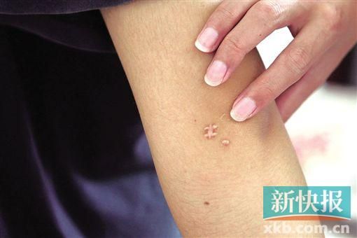 取出針后李星兒手臂留下了傷口。新快報記者 張國鋒/攝 取出針后李星兒手臂留下了傷口。新快報記者 張國鋒/攝