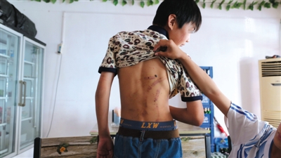 　昨日，奶西村，被打的小剛后背上條條瘀痕依然明顯。