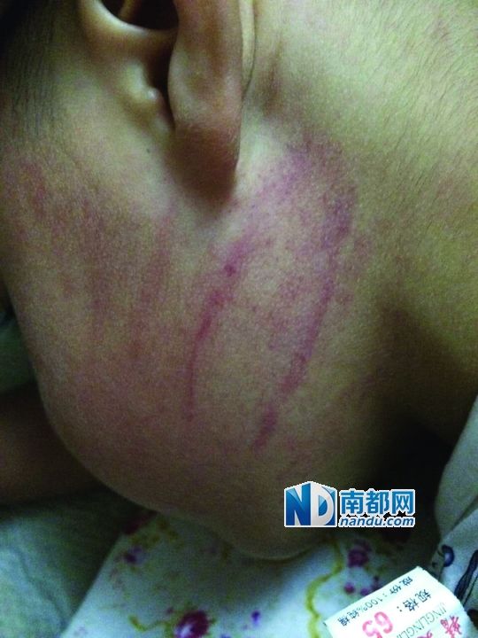 小逸臉上淤痕清晰可見。