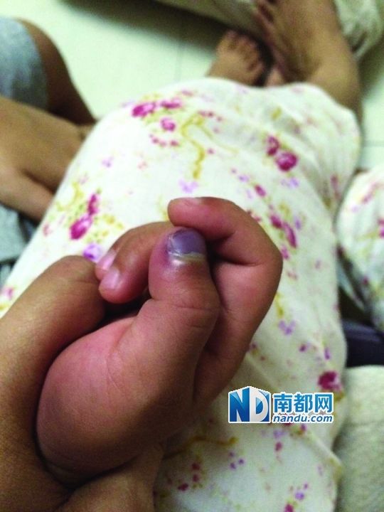 小逸手指被夾傷。