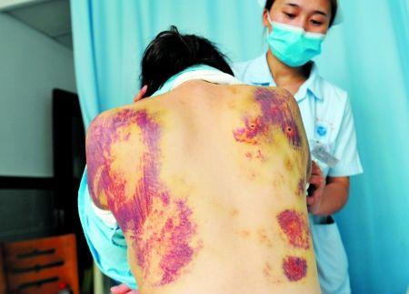 妻子被丈夫懷疑有外遇 懷孕7個月被打全身淤青 妻子被丈夫懷疑有外遇 懷孕7個月被打全身淤青