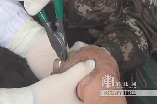 正在拆除戒指。