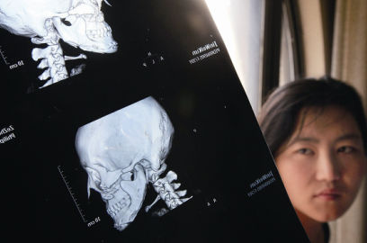 國內醫(yī)院CT顯示,如今靳魏坤的鼻子假體是歪的,連下巴也是歪的 國內醫(yī)院CT顯示,如今靳魏坤的鼻子假體是歪的,連下巴也是歪的