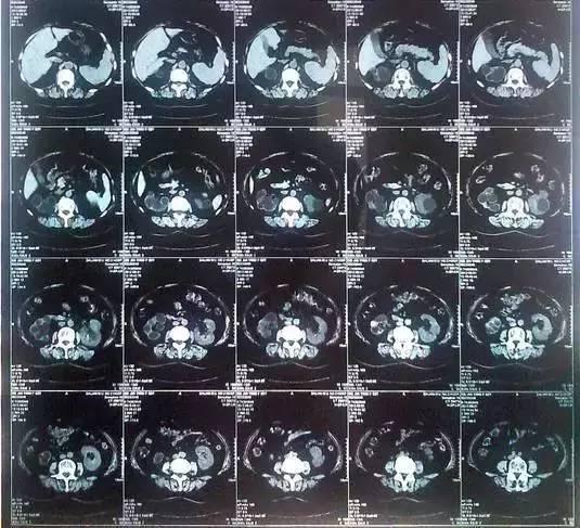 55歲大爺因愛吃豆腐 體內取出420顆結石 55歲大爺因愛吃豆腐 體內取出420顆結石