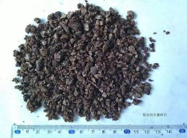 55歲大爺因愛吃豆腐 體內取出420顆結石 55歲大爺因愛吃豆腐 體內取出420顆結石