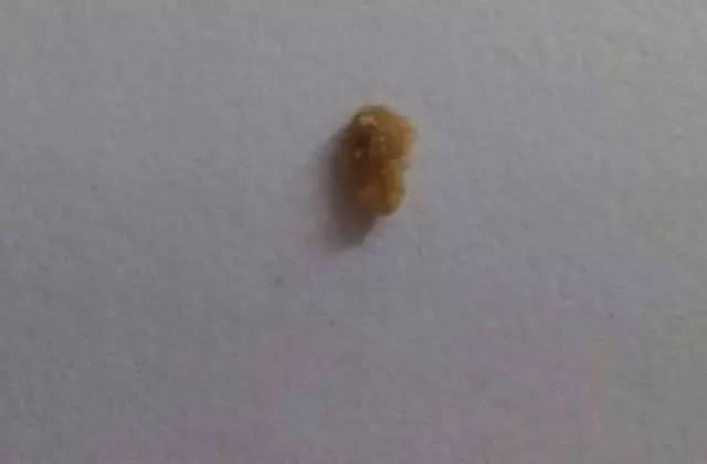 55歲大爺因愛吃豆腐 體內取出420顆結石 55歲大爺因愛吃豆腐 體內取出420顆結石