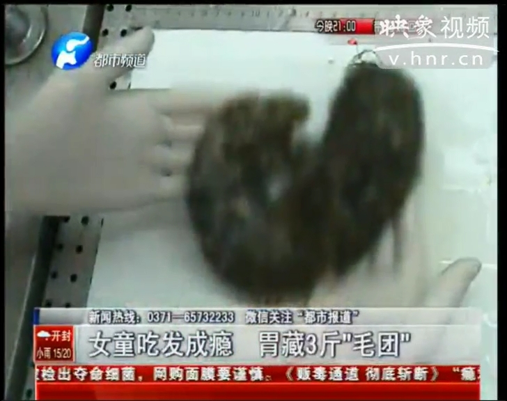 女童吃毛發成癮 胃藏3斤“毛團”